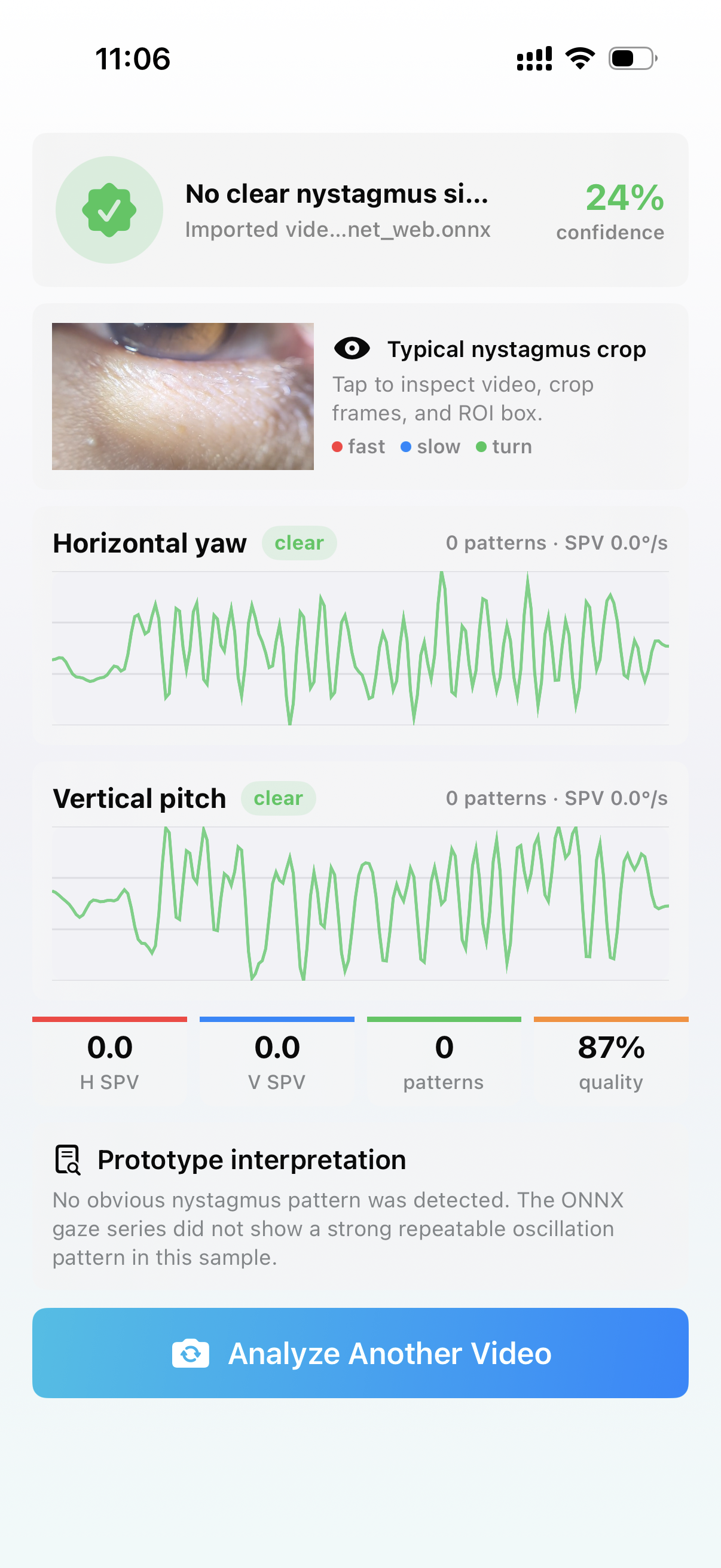 Home Nystagmus Monitor 分析结果界面